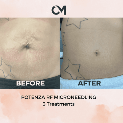 3 treatments of Potenza RF Microneedling