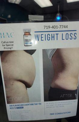 Actual patient's weight loss results with our medical weight loss program. This result was in 6 months.