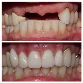 Who says a partial denture can't look great?  We love how this turned out!