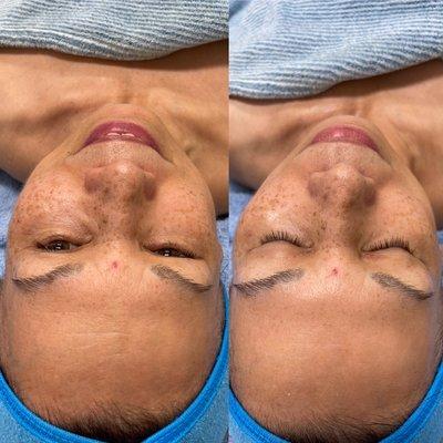 Lifting and toning facial