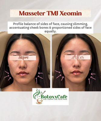 TMJ Masseter slimming, Jaw pain gone, natural V shape to her face