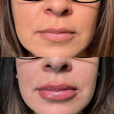 Before and After 
Lip FIller done by 
Nurse Celi