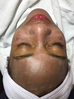 Chemical Peel (During).