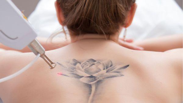 certified and approved tattoo removal laser