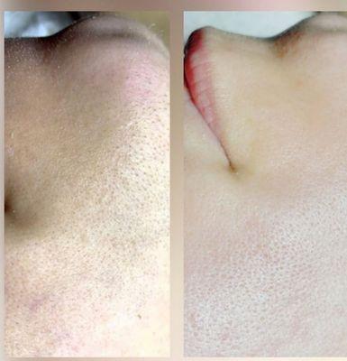 Before and after deep pore cleansing, micro & oxygen