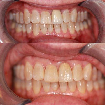 Before: an old style crown with poorly matched color. 
After: new crown with updated material and much better matched esthetic.