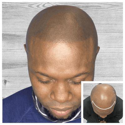 Scalp micropigmentation at new life scalp queens ny