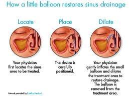 Balloon Sinus Dilation. The office based solution to traditional surgery. In and out in about 1 hr. Back to work the next day.