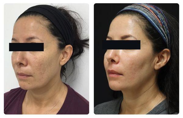 Facial rejuvenation before & after