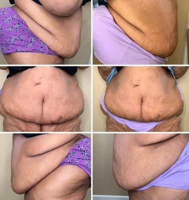 Gastric Bypass & sleeve surgery, 5 years no one helped with a maintenance program. We aid the process by cavitation & radio frequency.