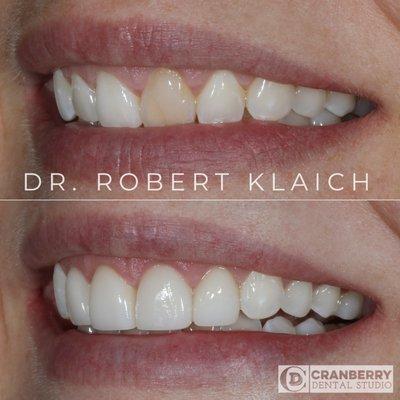 4 Porcelain veneers and crowns were used to address sizing and color concerns of this patient.