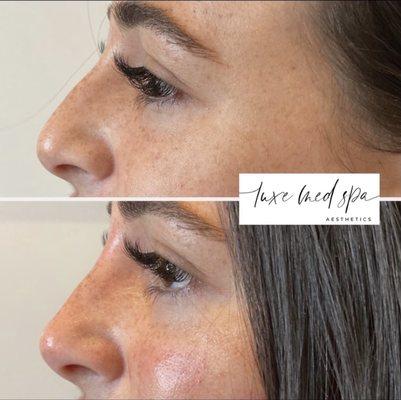 Non-Surgical Rhinoplasty (Nose Job) in Orlando, FL