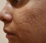 Acne scarring and hyper-pigmentation before treatment