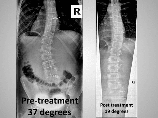 Non Surgical Scoliosis Treatment