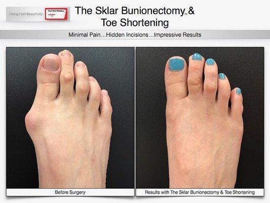 Get your feet picture perfect for summer with the Sklar Bunionectomy! Visit www.footfirst.com for more information.