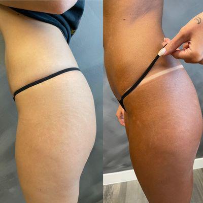 Be for and after luxury tan