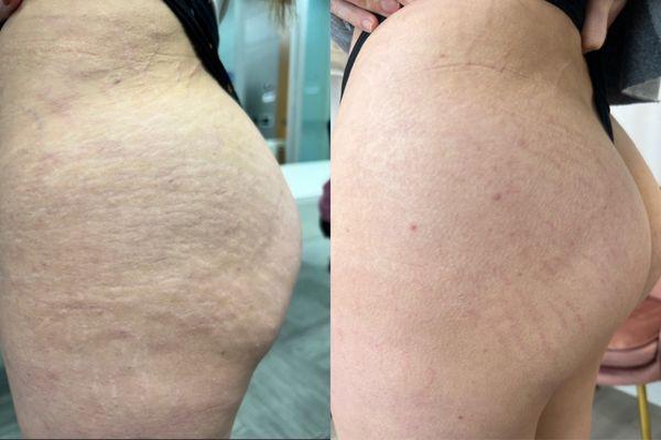 Stretch marks Inkless treatment to improve texture