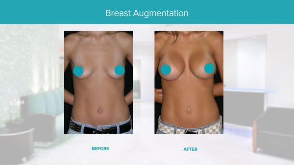 Real Results Before & After-Breast Augmentation