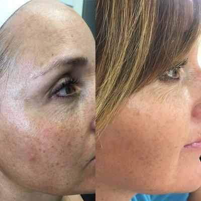 Chemical peel is perfect for smoothing skin