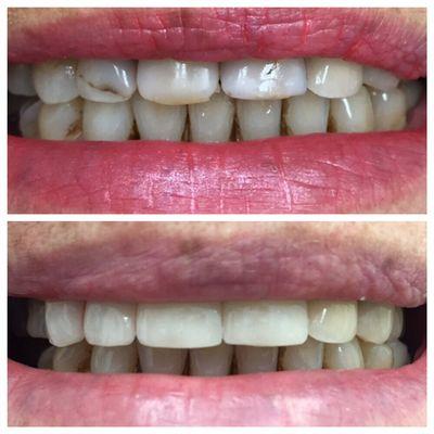 Before and after veneers