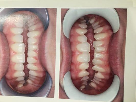 Befor and after veneers. Top 8. Bottom 8.