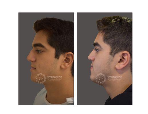 Rhinoplasty before and after