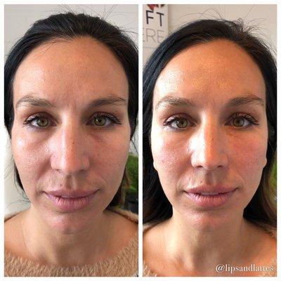 Before and after fillers under the eyes and temples.