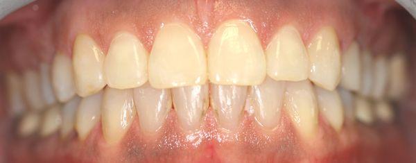 After orthodontic treatment