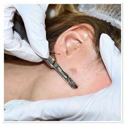 Dermaplaning is an effective exfoliating treatment using a surgical scalpel to gently scrape off deadskin cells from the surface of the skin