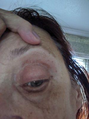 See red line over eyelid crease.. that is skin damage