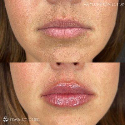 Lip Filler Injections!  Work by Erika at Peace Love Med Spa in Boca Raton, FL!