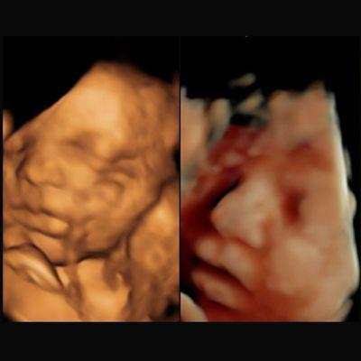 3D vs HD at 34 Weeks