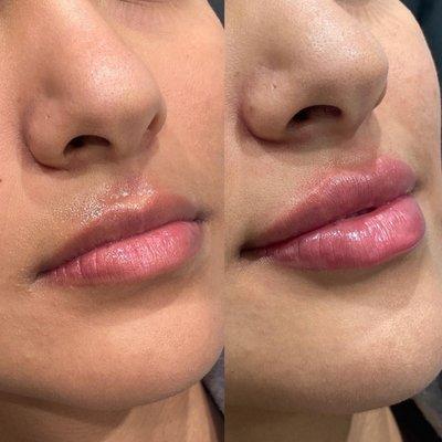 Lip filler doesn't have to look overfilled or overdone!