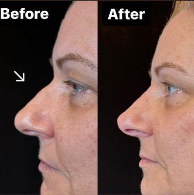 3-Point Rhinoplasty to balance the nasal profile!