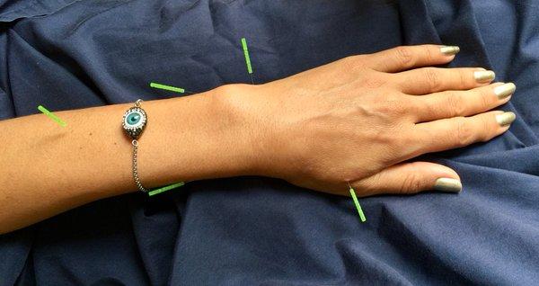 Acupuncture for pain in the wrist.