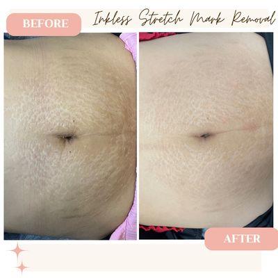 Pregancy Stretch Marks? Mothers are everything but stretch marks can be a burden, let us help!