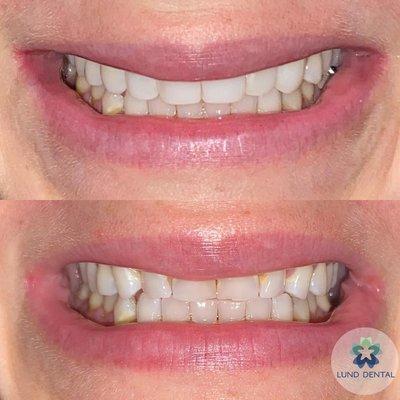 Bioclear before and after on upper teeth