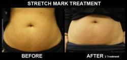 Before & After Stretchmark Correction