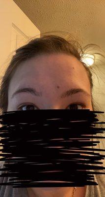 Missing hair from eyebrow.