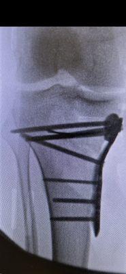 Knee fixation