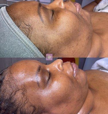 Dermaplaning Facial Before (top) After (bottom)