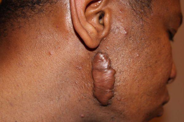 Keloid