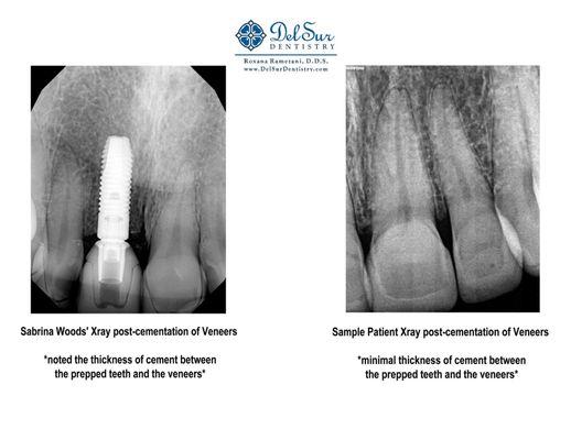 1 comparison photo from one of my 2nd opinions. My veneer placement looks nothing like the sample patient.