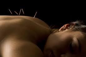 Acupuncture: Back Pain