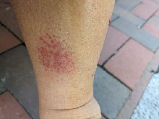 Burn on left leg from hot stones