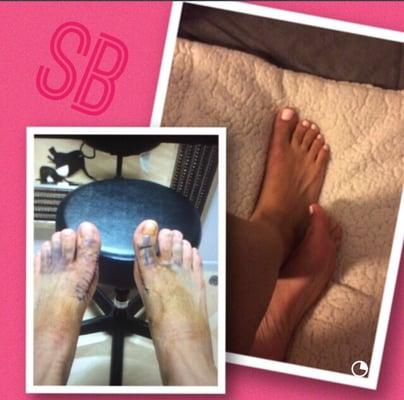 Thankyou DR did an amazing job. Bunion removal both feet a week apart. Pain free no scars fast recovery.Life changing experience