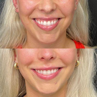 Happy Smiles with natural results from lip filler