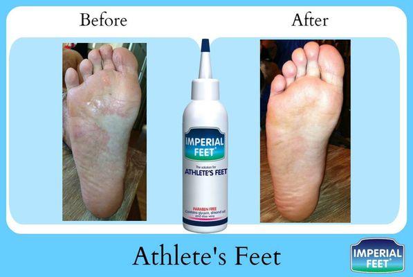 Athlete's Feet treatment