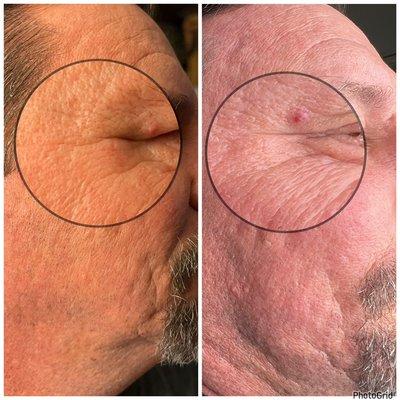 Procell treatment one (right) healed 3 weeks (left). Fine lines diminished!