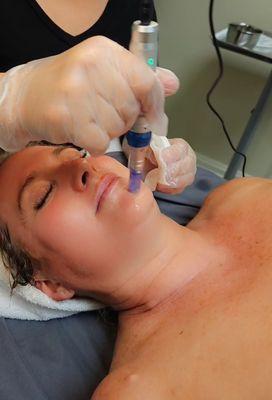 Microneedling